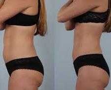 Fat Reduction result on woman